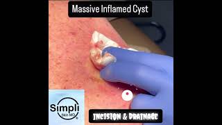 Massive Inflamed Cyst Incision amp Drainage [upl. by Rollo245]