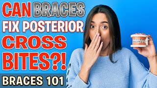 BRACES 101 Can Braces Fix POSTERIOR CROSSBITES  Treatment Minute Talk [upl. by Dick]