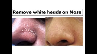 Turmeric to remove White heads on Nose Starnaturalbeauties [upl. by Becca]