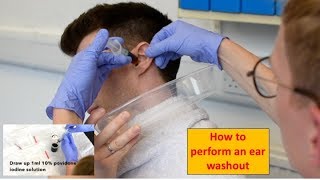 How to Perform an Ear Washout irrigation  ENTOtolaryngology Skills [upl. by Moreta]