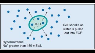 Hipernatremia [upl. by Siuqaj]