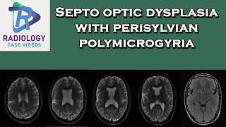 Septo optic dysplasia with perisylvian polymicrogyria [upl. by Nilre965]