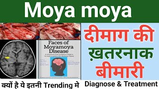 moyamoya disease in hindi  Diagnose amp treatment  moyamoya disease  moye moye song Drx Rabbani [upl. by Desiree41]