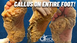 SHAVING CALLUS ON ENTIRE SOLE OF FOOT Dr Nick Campitelli Foot amp Ankle Surgeon [upl. by Buote]