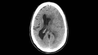 Subdural Hematoma  Before amp After [upl. by Qooraf]