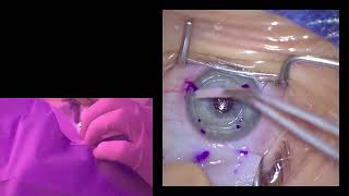 How to manage epithelial ingrowth after smile eye laser surgery CIRCLE mode [upl. by Reimer]