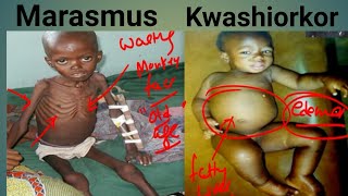 Protein Energy Malnutrition Biochemistry  Marasmus Vs Kwashiorkor  Kwashiorkor  Marasmus [upl. by Merp]