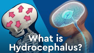 What is Hydrocephalus and Why Does Fluid Build Up in the Brain [upl. by Lennor381]