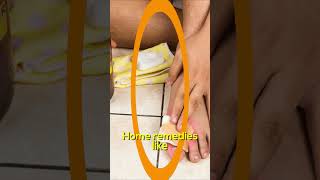 BEST Athletes Foot Fungus Treatments HOME Remedies  BIG SECRETS PT2 [upl. by Ricca]