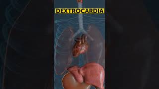 Do You Know What Is Dextrocardia shorts [upl. by Georgina799]