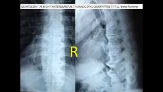 Lecture on DISH diffuse idiopathic skeletal hyperstosis of the spine [upl. by Veda645]