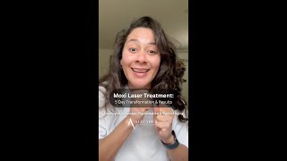 Moxi Laser Treatment 5 Day Transformation amp Results [upl. by Chapnick]