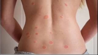 Pityriasis Rosea [upl. by Nelaf]