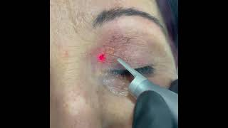 Xanthelasma removal with Co2 laser [upl. by Marigolde316]