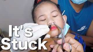 Foreign Body Stuck In Girls Nose Removal  What is it [upl. by Boutis]