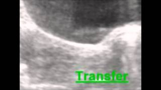 Der Embryotransfer [upl. by Judon65]