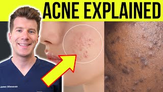 Doctor explains ACNE  Causes symptoms treatment and more [upl. by Bethina]