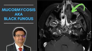 Mucormycosis AKA Black Fungus  All You Need To Know  Dr Parang Sanghavi [upl. by Ferris577]