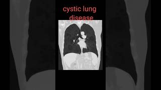 cystic lung disease shorts radiology lungsdisease radiologyjunction [upl. by Fatimah]