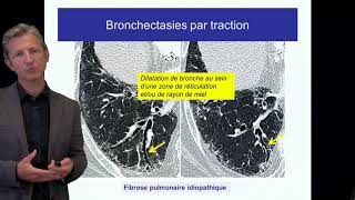 Fibrose pulmonaire Cottin Cours DES 2017 criteres diagnostiques FPI [upl. by Julina]