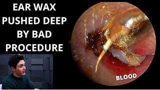 Ear Wax Pushed Down By Negligent Procedure Ear ImpressionsMouldings [upl. by Akkimat]