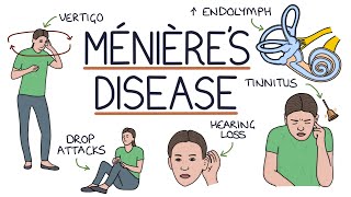 Understanding Ménière’s Disease [upl. by Annaohj]