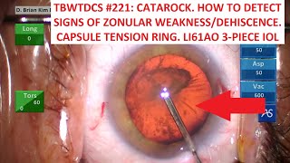 TBWTDCS 221 How To Detect Signs amp Manage Weak Zonules Capsule Tension Ring LI61AO IOL [upl. by Nyla63]