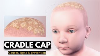 Cradle Cap Causes Signs and Symptoms Diagnosis and Treatment [upl. by Valerle734]