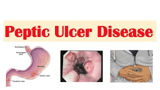 Peptic Ulcer Disease Gastric vs Duodenal Ulcers  Causes Symptoms Diagnosis Treatment [upl. by Marjy]