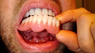 Wearing dentures 48 hours after extraction immediate dentures [upl. by Esoryram]