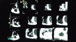 Rechter Ventrikel mit MultiSliceBildgebung  right ventricle with multislice imaging [upl. by Annawyt284]