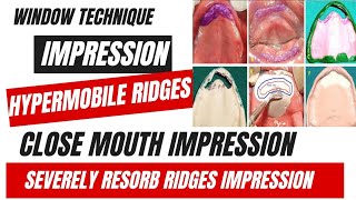 Impression techniques For Compromised patient  Hypermobile ridge impression  Severely Resorb Ridg [upl. by Melgar]