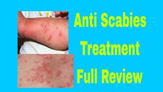 AntiScabies Treatment In Urdu [upl. by Anehs901]