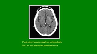 Neurology Quiz 84 Diabetic Striatopathy [upl. by Martell]