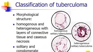 Secondary tuberculosis Focal tuberculosis Tuberculoma Infiltrative tuberculosis [upl. by Pinckney937]