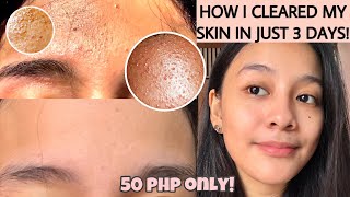 HOW TO GET RID OF TINY BUMPS ON FOREHEADFACE FAST  FUNGAL ACNE how i cleared my skin ENG SUB [upl. by Alakcim]