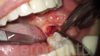 Horizontal Impacted Wisdom Tooth  Sonic Surgery  Dr Fabio Cozzolino  Zerodonto [upl. by Osei]