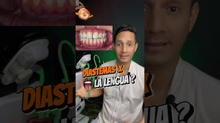 Diastemas por culpa de la LEMGUA 😛 brackets ortodoncia diastema [upl. by Anividul]