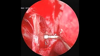 ESPAL  Endoscopic Sphenopalatine Artery Ligation  Cautery [upl. by Hackney]