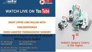 VIDEO ASSISTED THORACOSCOIC SURGERY FOR RIGHT UPPER LOBE BULLAE WITH PNEUMOTHORAX [upl. by Oloap]