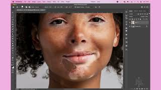 Vitiligo Model Photoshop Retouch [upl. by Sirdi579]