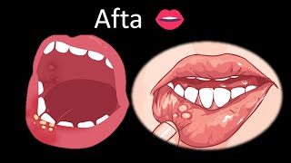 👄 Aftas  Cavidad oral  Cabeza y Cuello  Patología [upl. by Noneek524]