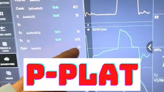 How to check Plateau Pressure PPlat on a MAQUET SERVOU VENTILATOR [upl. by Aehsa]