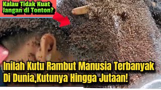 Kutu Rambut Manusia Terbanyak di Dunia  Kutunya Hingga Jutaan ⁉️ [upl. by Ricarda]