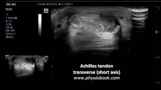 Achilles tendon tear  MSK ultrasound [upl. by Ulrika321]