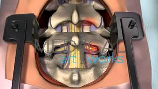 3D Medical Animation  Lumbar spine surgical procedure 2 level fusion of L4S1 [upl. by Yma]