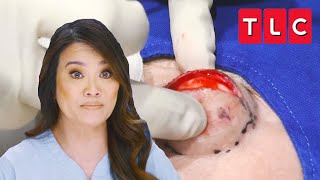 Dr Lee Squeezes “Devil Horn” Cyst off the Forehead of a Patient  Dr Pimple Popper  TLC [upl. by Ayortal774]