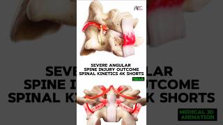 Severe Angular Spine Injury Outcome  Spinal Kinetics 4K shorts medical animation 3d short [upl. by Domela]