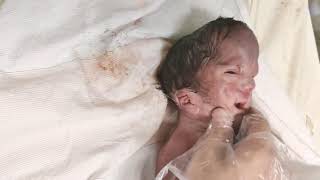 Newborn baby abandoned by parents due to congenital malformations just after birth birth [upl. by Arleta386]