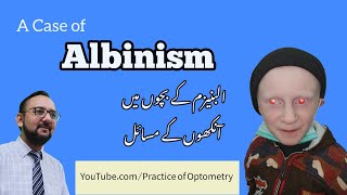 Albino  Albinism  Oculocutaneous Albinism  Why Are Some Children Albino  Practice Of Optometry [upl. by Nomde]